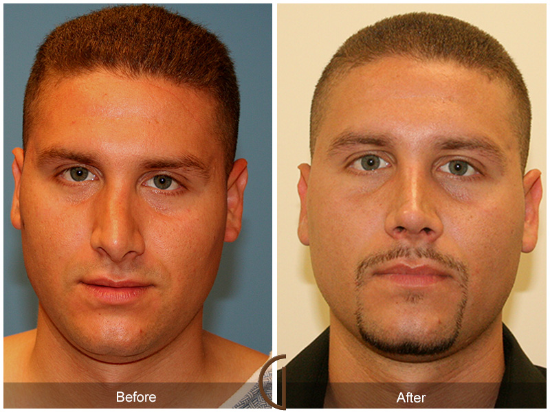 Male Rhinoplasty Before & After Image