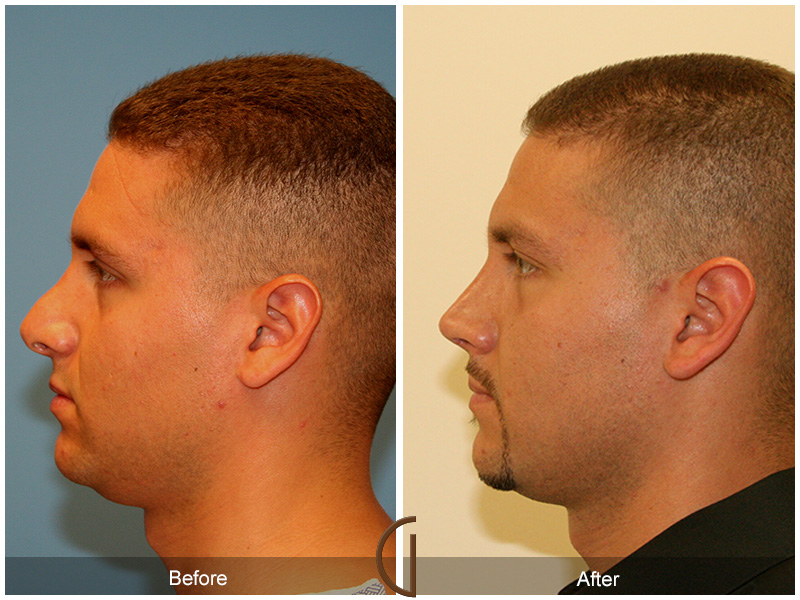 Male Rhinoplasty Before & After Image