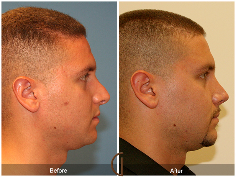 Male Rhinoplasty Before & After Image