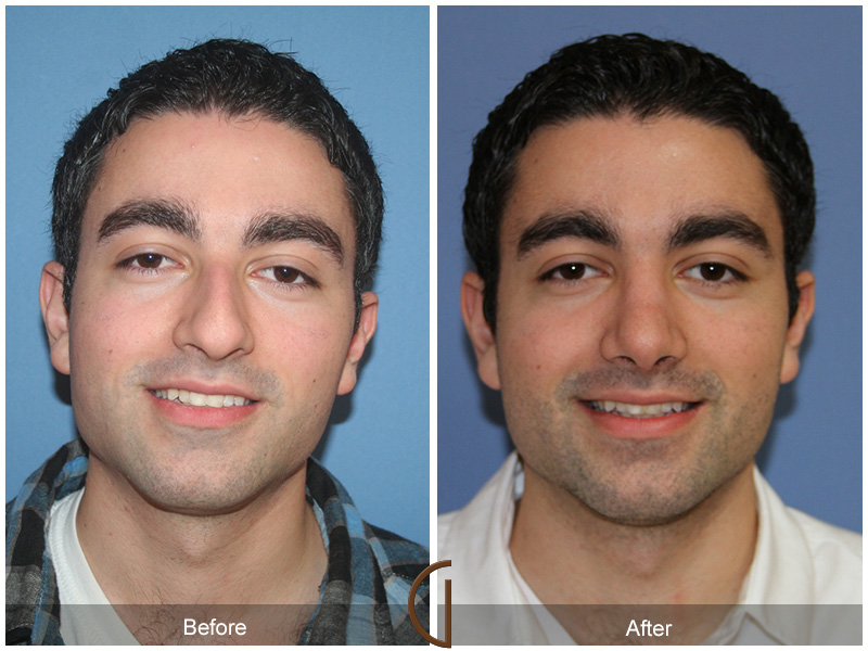 Male Rhinoplasty Before & After Image