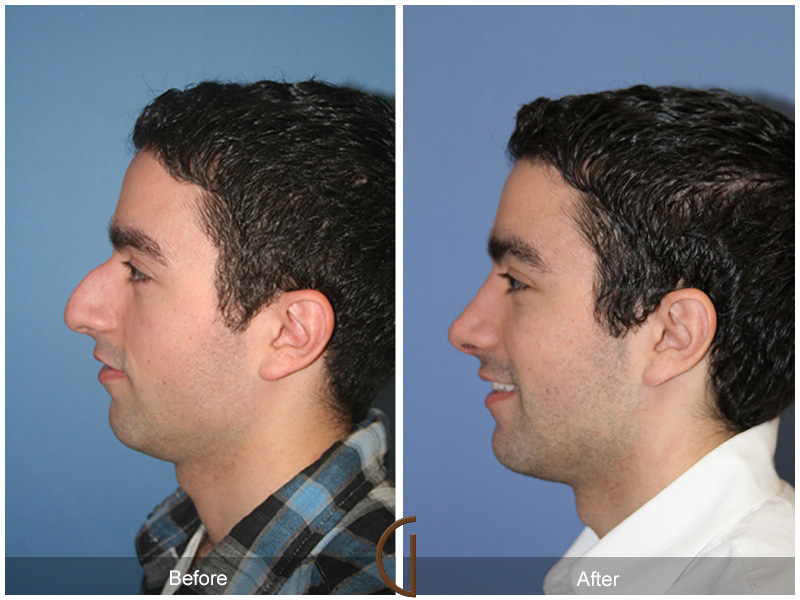 Male Rhinoplasty Before & After Image