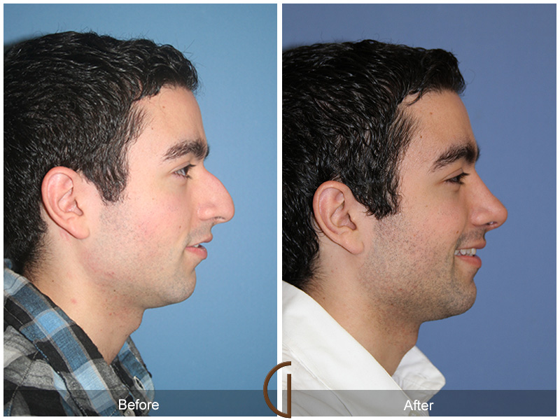 Male Rhinoplasty Before & After Image