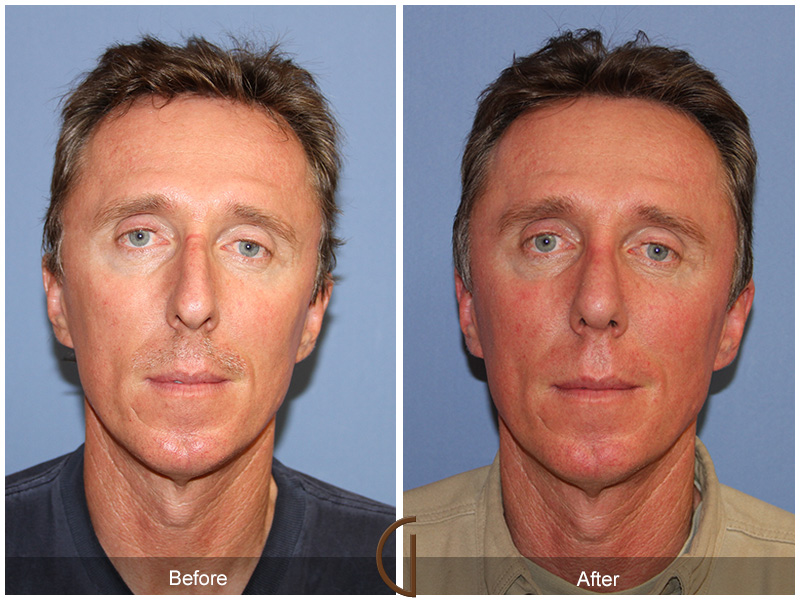 Male Rhinoplasty Before & After Image