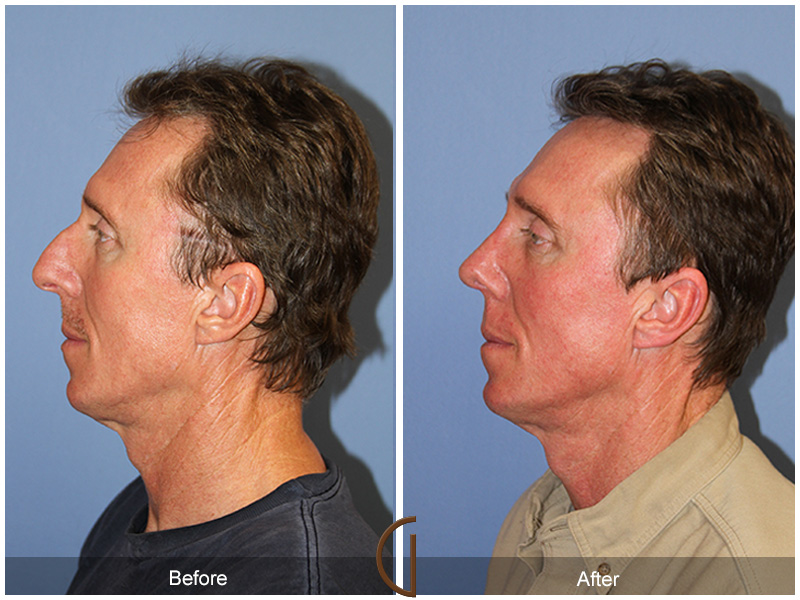 Male Rhinoplasty Before & After Image