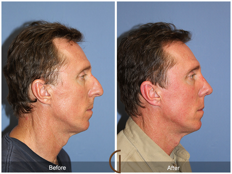 Male Rhinoplasty Before & After Image