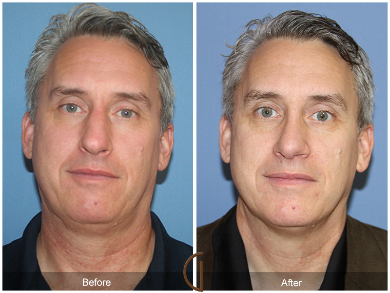 Male Rhinoplasty Before & After Image