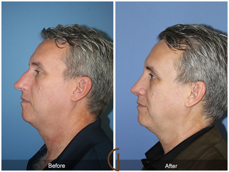 Male Rhinoplasty Before & After Image