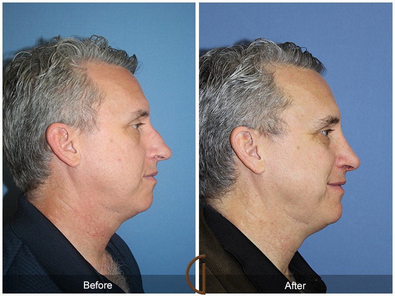 Male Rhinoplasty Before & After Image