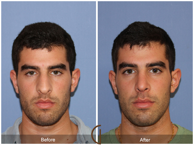 Male Rhinoplasty Before & After Image