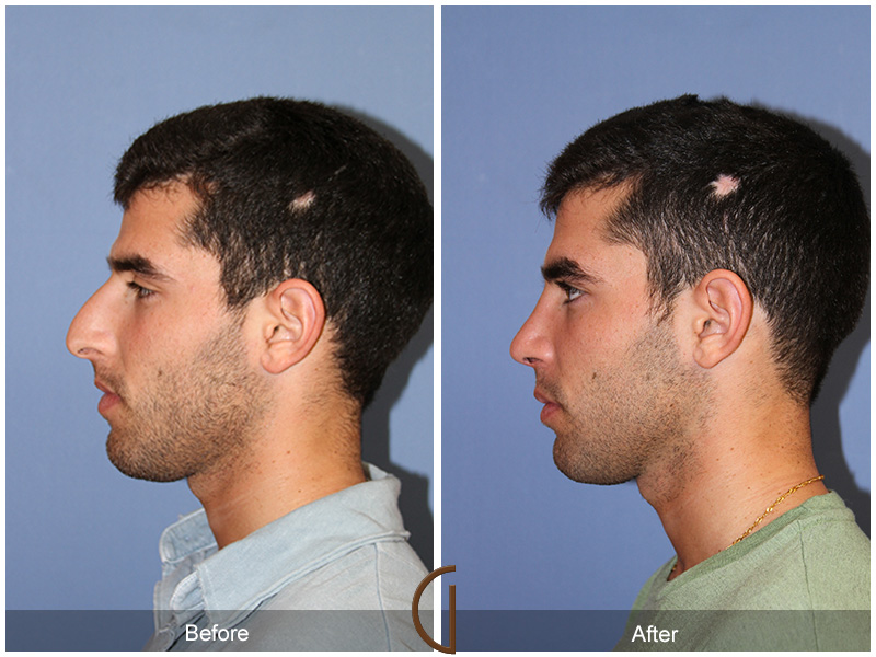 Male Rhinoplasty Before & After Image