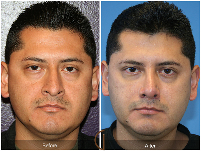 Male Rhinoplasty Before & After Image