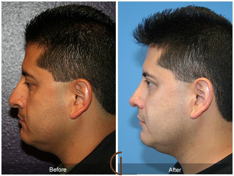 Male Rhinoplasty Before & After Image