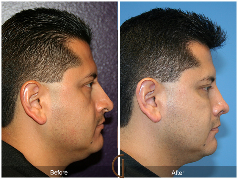 Male Rhinoplasty Before & After Image