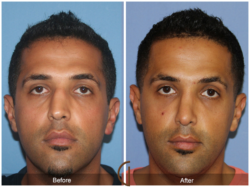 Male Rhinoplasty Before & After Image