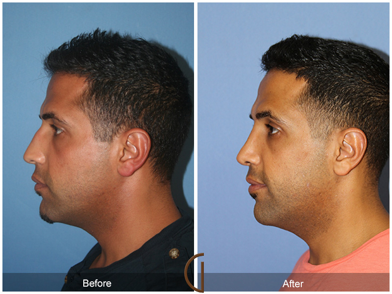 Male Rhinoplasty Before & After Image