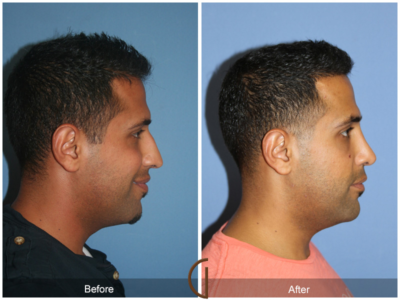 Male Rhinoplasty Before & After Image