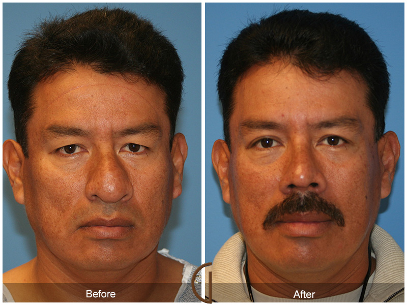 Male Rhinoplasty Before & After Image