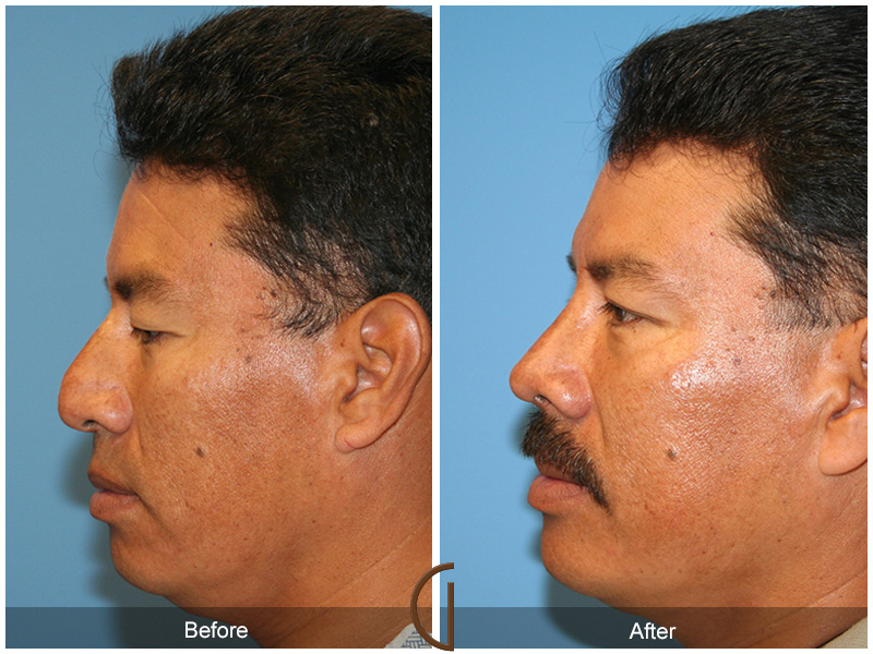 Male Rhinoplasty Before & After Image