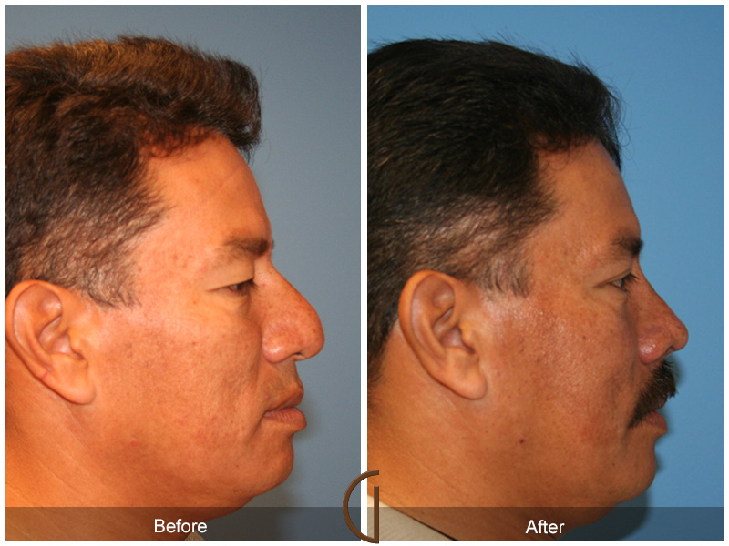 Male Rhinoplasty Before & After Image