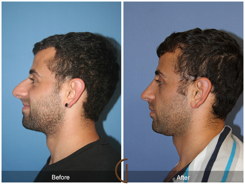 Male Rhinoplasty Before & After Image