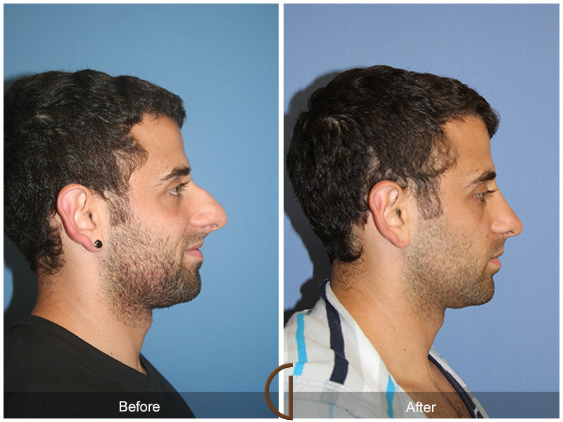 Male Rhinoplasty Before & After Image