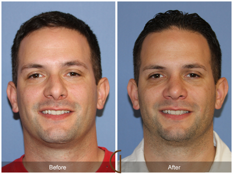 Male Rhinoplasty Before & After Image