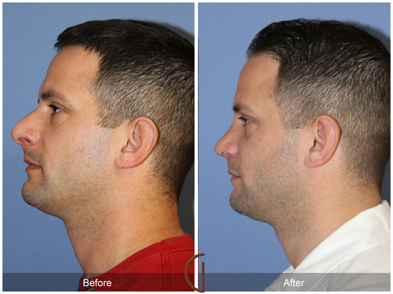 Male Rhinoplasty Before & After Image