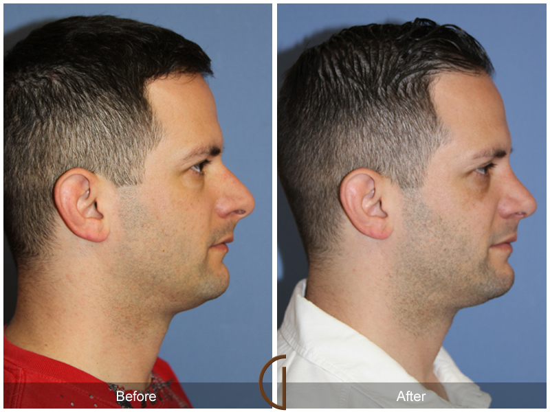 Male Rhinoplasty Before & After Image