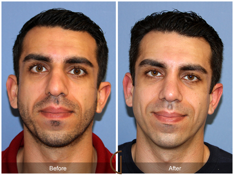 Male Rhinoplasty Before & After Image