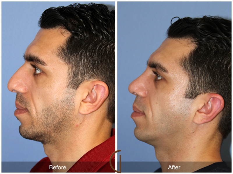 Male Rhinoplasty Before & After Image