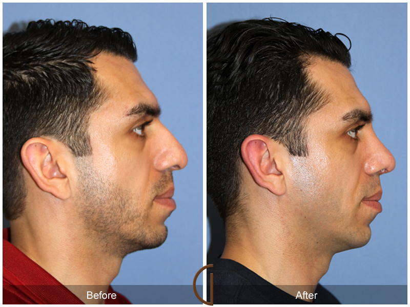 Male Rhinoplasty Before & After Image