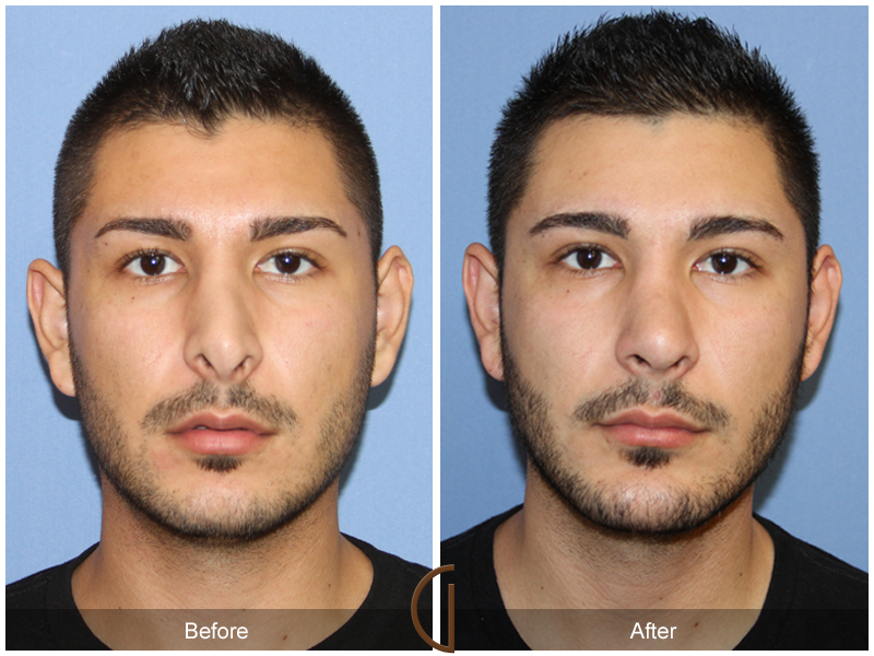 Male Rhinoplasty Before & After Image