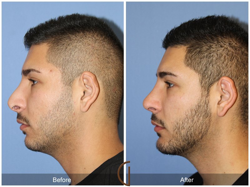 Male Rhinoplasty Before & After Image