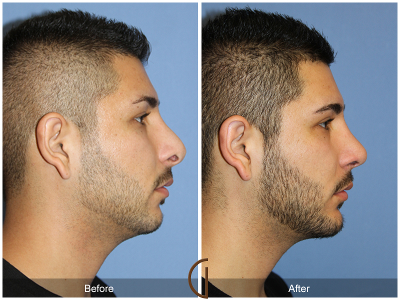 Male Rhinoplasty Before & After Image