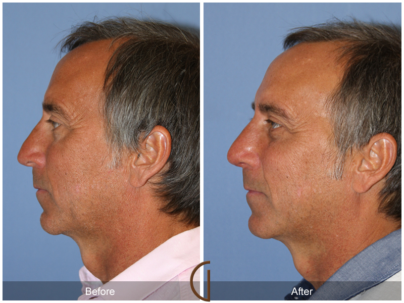 Male Rhinoplasty Before & After Image