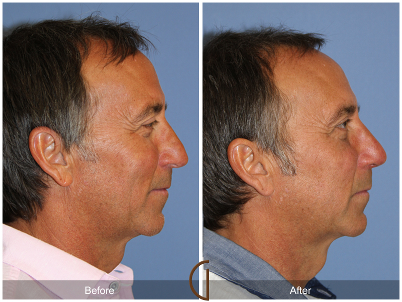 Male Rhinoplasty Before & After Image