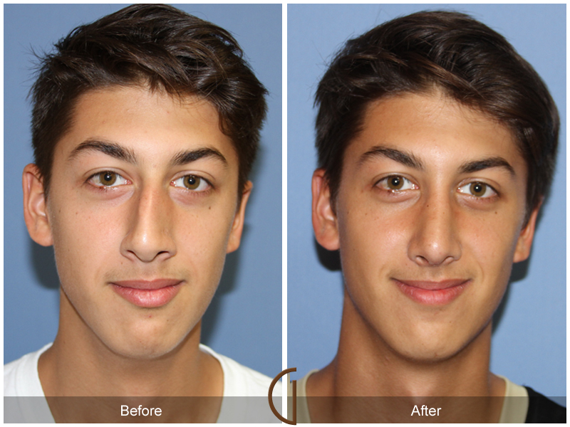 Male Rhinoplasty Before & After Image