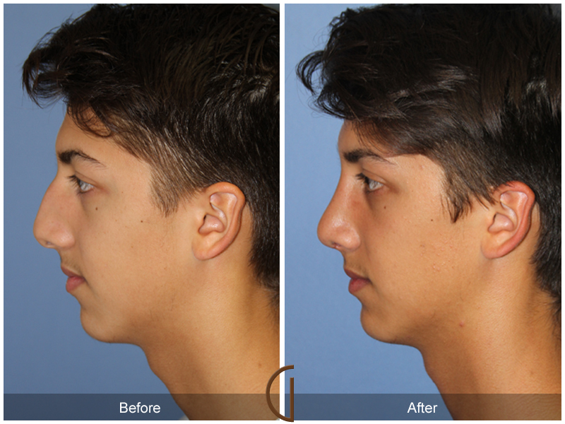 Male Rhinoplasty Before & After Image