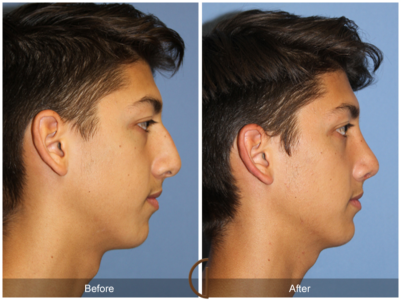 Male Rhinoplasty Before & After Image