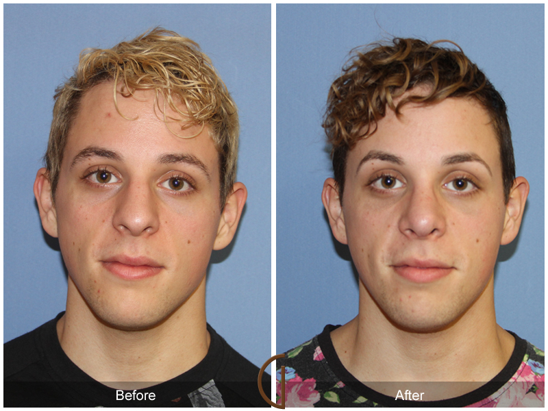 Male Rhinoplasty Before & After Image