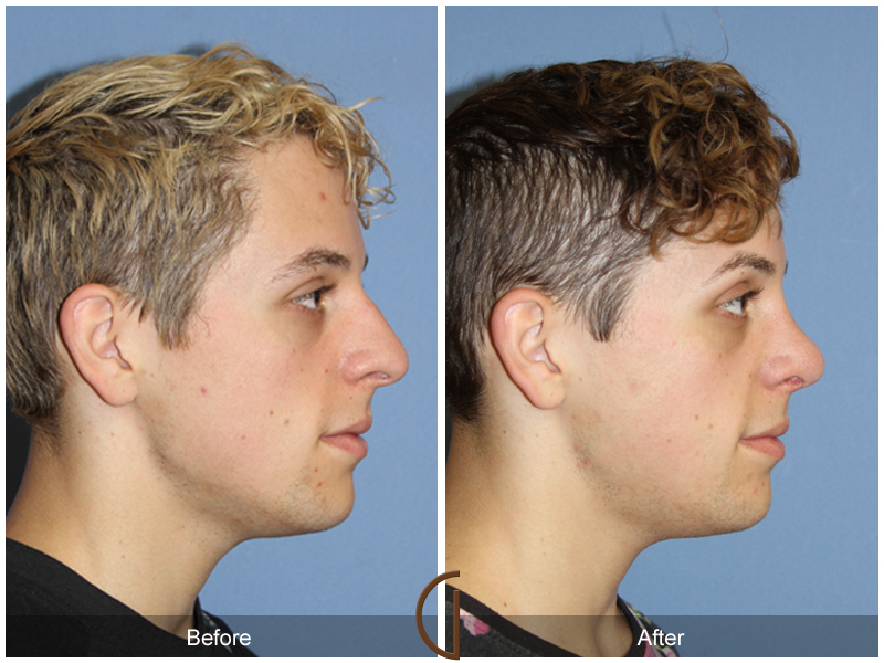 Male Rhinoplasty Before & After Image