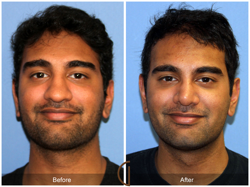 Male Rhinoplasty Before & After Image