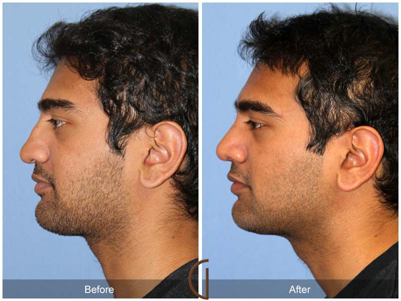 Male Rhinoplasty Before & After Image