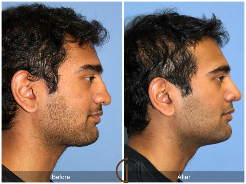 Male Rhinoplasty Before & After Image