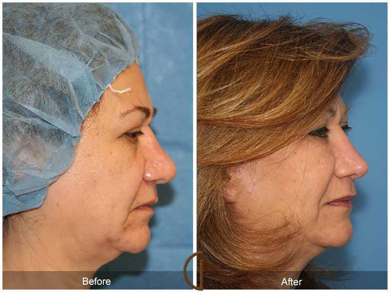 Revision Rhinoplasty Before & After Image