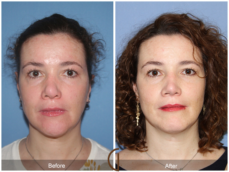 Revision Facelift Orange County Facelift Revision Newport Beach Dr