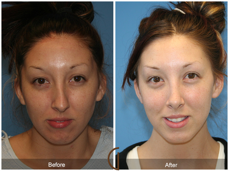 Teen Rhinoplasty Before & After Image