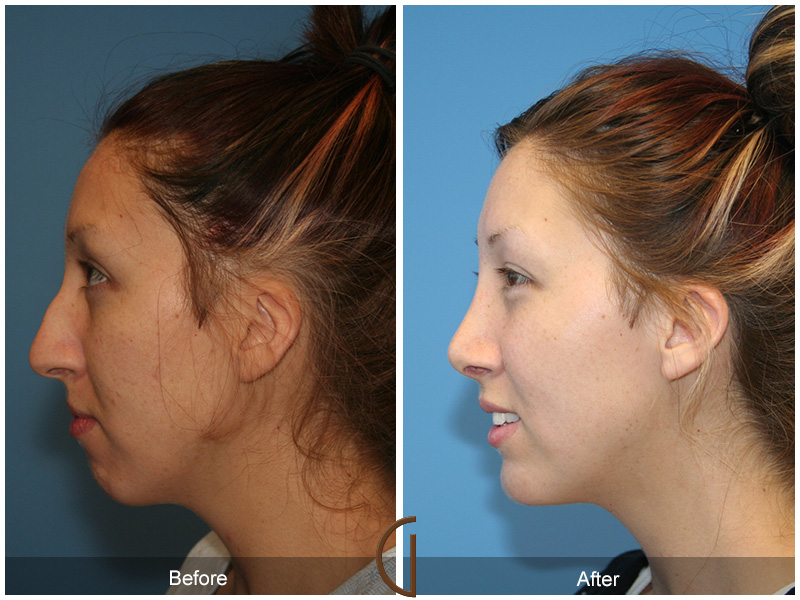 Teen Rhinoplasty Before & After Image