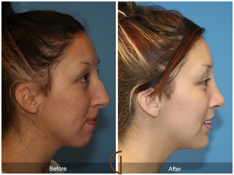 Teen Rhinoplasty Before & After Image