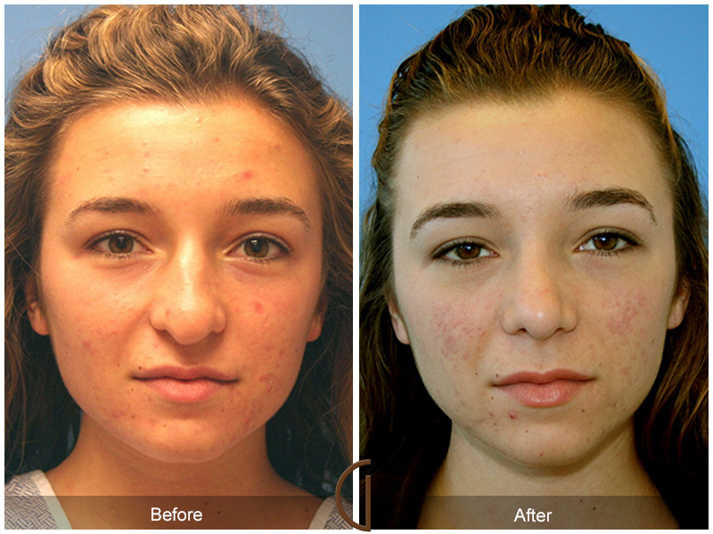 Teen Rhinoplasty Before & After Image